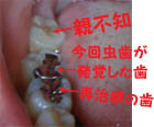 歯の治療